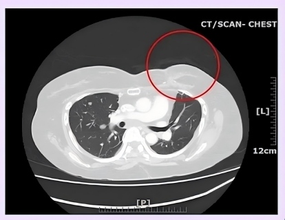 Tsing-Hua University Achieves BNCT Treatment for Breast Cancer