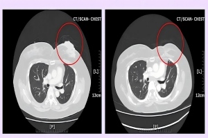 After breast cancer patients receive BNCT treatment